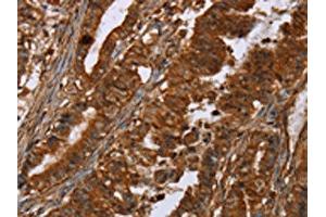 The image on the left is immunohistochemistry of paraffin-embedded Human esophagus cancer tissue using ABIN7191964(POU6F2 Antibody) at dilution 1/30, on the right is treated with synthetic peptide. (POU6F2 anticorps)