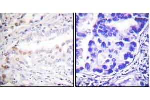 Immunohistochemistry analysis of paraffin-embedded human lung carcinoma tissue using Uba2 antibody. (UBA2 anticorps)