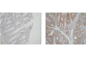 Left and Center: Immunohistochemical staining of normal colon tissue and colon carcinoma tissue using ATIC antibody . (ATIC anticorps)