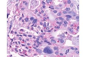 Anti-GPR150 antibody IHC of human Pancreas, Carcinoma. (GPR150 anticorps  (N-Term))