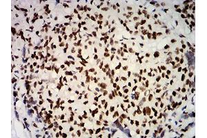 Immunohistochemical analysis of paraffin-embedded breast cancer tissues using ESR1 mouse mAb with DAB staining. (Estrogen Receptor alpha anticorps  (AA 2-185))