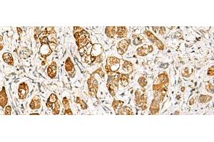 Immunohistochemistry of paraffin-embedded Human liver cancer tissue using RIMS3 Polyclonal Antibody at dilution of 1:60(x200) (RIMS3 anticorps)
