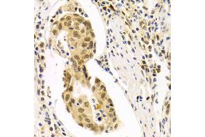 Immunohistochemistry of paraffin-embedded Human gastric cancer using DLGAP5 antibody at dilution of 1:100 (x400 lens).