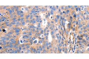 Immunohistochemistry of paraffin-embedded Human ovarian cancer tissue using IGFBP7 Polyclonal Antibody at dilution 1:50 (IGFBP7 anticorps)