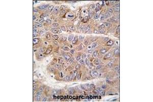Formalin-fixed and paraffin-embedded human hepatocarcinoma tissue reacted with IRS2 antibody (C-term), which was peroxidase-conjugated to the secondary antibody, followed by DAB staining. (IRS2 anticorps  (C-Term))