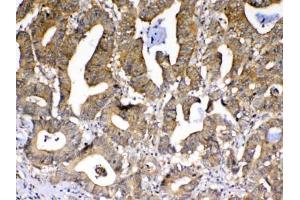 IHC testing of FFPE human rectal cancer tissue with PPID antibody at 1ug/ml. (PPID anticorps)