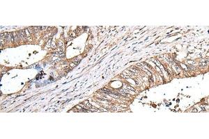 Immunohistochemistry of paraffin-embedded Human colorectal cancer tissue using ZNHIT1 Polyclonal Antibody at dilution of 1:40(x200)