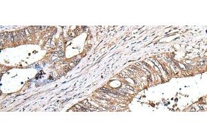 Immunohistochemistry of paraffin-embedded Human colorectal cancer tissue using ZNHIT1 Polyclonal Antibody at dilution of 1:40(x200) (ZNHIT1 anticorps)