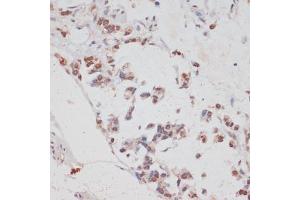 Immunohistochemistry of paraffin-embedded human gastric cancer using HT antibody (ABIN7267756) at dilution of 1:100 (40x lens). (HTATSF1 anticorps  (AA 1-180))