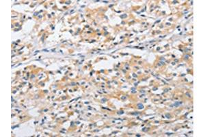 The image on the left is immunohistochemistry of paraffin-embedded Human thyroid cancer tissue using ABIN7128506(ARHGEF9 Antibody) at dilution 1/50, on the right is treated with fusion protein. (Arhgef9 anticorps)