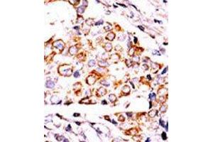 Formalin-fixed and paraffin-embedded human cancer tissue reacted with the primary antibody, which was peroxidase-conjugated to the secondary antibody, followed by DAB staining. (NME3 anticorps  (AA 59-88))