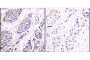 Immunohistochemistry analysis of paraffin-embedded human breast carcinoma tissue, using TGF beta3 Antibody. (TGFB3 anticorps  (AA 261-310))