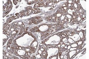 IHC-P Image Immunohistochemical analysis of paraffin-embedded gastric cancer N87 xenograft, using AK3L1, antibody at 1:100 dilution. (AK4 anticorps)