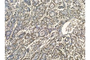 MCM2 Mouse Monoclonal Antibody at 1/100 staining human colorectal cancer by IHC-P. (MCM2 anticorps)