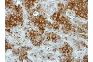 IHC-P Image Immunohistochemical analysis of paraffin-embedded BT474 xenograft, using Deltex1, antibody at 1:500 dilution. (Deltex Homolog 1 anticorps  (Center))
