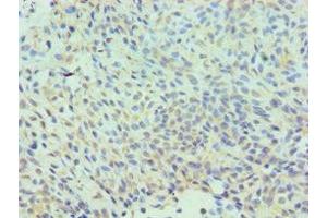 Immunohistochemistry of paraffin-embedded human breast cancer using ABIN7147585 at dilution of 1:100