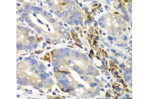 Immunohistochemistry of paraffin-embedded Human gastric cancer using AIMP1 Polyclonal Antibody at dilution of 1:100 (40x lens). (AIMP1 anticorps)