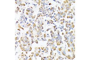 Immunohistochemistry of paraffin-embedded human liver cancer using RHOG antibody (ABIN7269864) at dilution of 1:100 (40x lens). (RHOG anticorps)