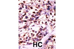 Formalin-fixed and paraffin-embedded human cancer tissue reacted with UCK2 polyclonal antibody  , which was peroxidase-conjugated to the secondary antibody, followed by DAB staining. (UCK2 anticorps  (N-Term))