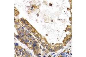 Immunohistochemistry of paraffin-embedded human stomach cancer using GYS1 antibody. (Glycogen Synthase 1 anticorps  (AA 488-737))