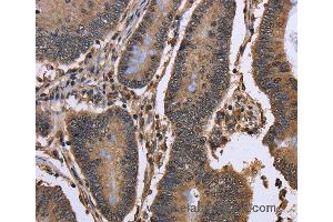 Immunohistochemistry of Human colon cancer using DCP1A Polyclonal Antibody at dilution of 1:50 (DCP1A anticorps)
