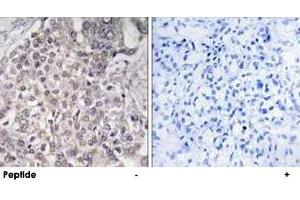 Immunohistochemistry analysis of paraffin-embedded human liver carcinoma tissue using CYP4F2 polyclonal antibody . (CYP4F2 anticorps)