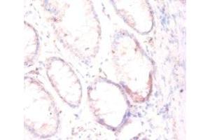 Immunohistochemistry of paraffin-embedded human colon cancer using ABIN7153948 at dilution of 1:50