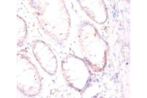 Immunohistochemistry of paraffin-embedded human colon cancer using ABIN7153948 at dilution of 1:50 (PSMA anticorps  (AA 48-750))