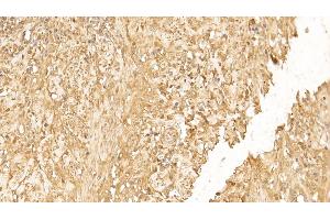 Detection of CK18 in Human Endometrial cancer Tissue using Monoclonal Antibody to Cytokeratin 18 (CK18)