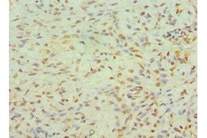 Immunohistochemistry of paraffin-embedded human breast cancer using ABIN7145557 at dilution of 1:100 (JMJD6 anticorps  (AA 1-320))