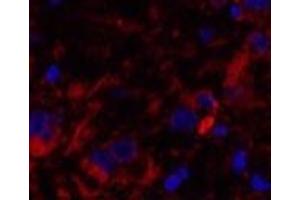 Immunofluorescence analysis of Human breast cancer tissue using Cleaved-CASP8 (D384) Polyclonal Antibody at dilution of 1:200.