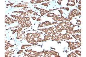 Formalin-fixed, paraffin-embedded human Breast Carcinoma stained with Histone H1 Rabbit Recombinant Monoclonal Antibody (AE-4). (Recombinant Histone H1 anticorps)
