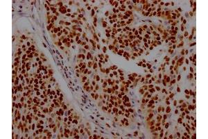 IHC image of ABIN7127571 diluted at 1:100 and staining in paraffin-embedded human cervical cancer performed on a Leica BondTM system. (Recombinant Interleukin enhancer-binding factor 3 (ILF3) anticorps)