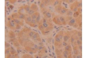 Detection of TPS in Human Liver cancer Tissue using Polyclonal Antibody to Tryptase (TPS)