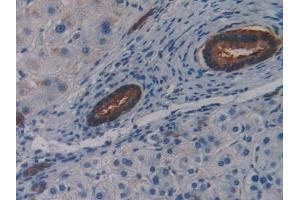 Detection of LSR in Human Liver cancer Tissue using Polyclonal Antibody to Lipolysis Stimulated Lipoprotein Receptor (LSR)