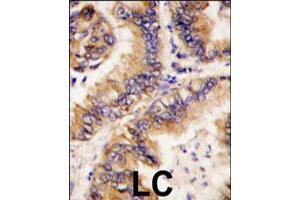 Formalin-fixed and paraffin-embedded human lung carcinoma tissue reacted with TRAPPC4 polyclonal antibody  , which was peroxidase-conjugated to the secondary antibody, followed by DAB staining. (TRAPPC4 anticorps  (N-Term))