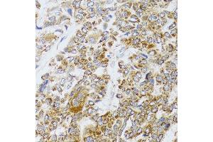 Immunohistochemistry of paraffin-embedded human liver cancer using AIFM3 antibody (ABIN5996156) at dilution of 1/100 (40x lens). (AIFM3 anticorps)