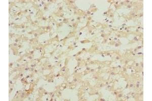 Immunohistochemistry of paraffin-embedded human liver cancer using ABIN7144572 at dilution of 1:100
