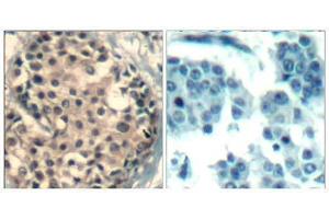 Immunohistochemical analysis of paraffin-embedded human breast carcinoma tissue using HDAC4/HDAC5/ HDAC9 (phospho-Ser246/259/220) Antibody (E011517). (HDAC4/HDAC5/HDAC9 anticorps  (pSer220, pSer246, pSer259))