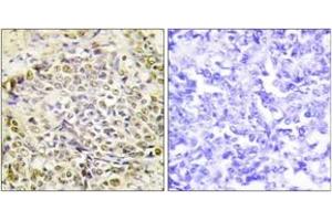 Immunohistochemistry analysis of paraffin-embedded human lung carcinoma tissue, using IRX2 Antibody. (IRX2 anticorps  (AA 231-280))