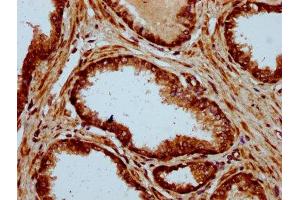 IHC image of ABIN7150052 diluted at 1:500 and staining in paraffin-embedded human prostate cancer performed on a Leica BondTM system.