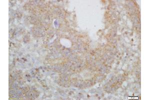Formalin-fixed and paraffin embedded human gastric carcinoma labeled with Rabbit Anti-ARPC2/p34-ARC Polyclonal Antibody, Unconjugated  at 1:200 followed by conjugation to the secondary antibody and DAB staining (ARPC2 anticorps  (AA 201-300))