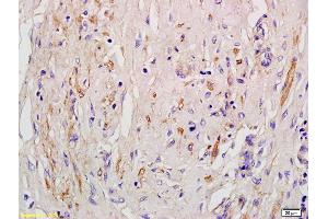 Formalin-fixed and paraffin embedded human pneumonic lung tissue labeled with Anti-EDG4/LPA2 Polyclonal Antibody, Unconjugated (ABIN681118) at 1:200 followed by conjugation to the secondary antibody and DAB staining (Angiotensin II Type-1 Receptor anticorps)