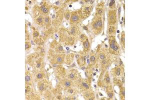 Immunohistochemistry of paraffin-embedded human liver damage using Slug Antibody (ABIN6127298, ABIN6148181, ABIN6148183 and ABIN6217314) at dilution of 1:100 (40x lens). (SLUG anticorps  (AA 126-268))