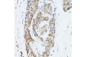 Immunohistochemistry of paraffin-embedded human esophageal cancer using TOLLIP antibody (ABIN5971228) at dilution of 1/100 (40x lens). (TOLLIP anticorps)