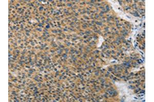 The image on the left is immunohistochemistry of paraffin-embedded Human liver cancer tissue using ABIN7128398(ANAPC13 Antibody) at dilution 1/25, on the right is treated with fusion protein.