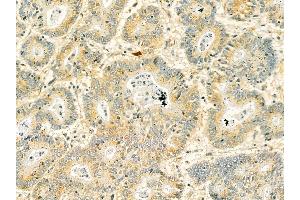 SPTBN1 Mouse Monoclonal Antibody at 1/100 staining human colorectal cancer by IHC-P. (SPTBN1 anticorps  (N-Term))