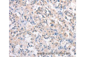 Immunohistochemistry of Human thyroid cancer using CRHR2 Polyclonal Antibody at dilution of 1:25 (CRHR2 anticorps)