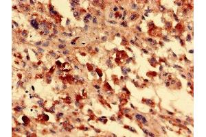Immunohistochemistry analysis of human melanoma using ABIN7153105 at dilution of 1:100 (FOXR2 anticorps  (AA 1-300))