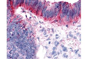 Anti-GPER1 / GPR30 antibody IHC of human Colon, Carcinoma. (GPER anticorps  (Extracellular Domain))